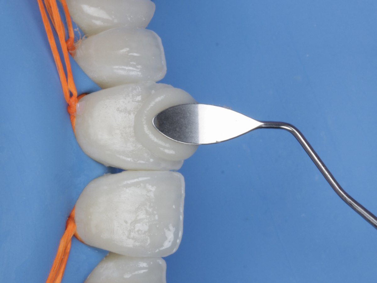 Instrument placing composite on an anterior tooth isolated under rubber dam