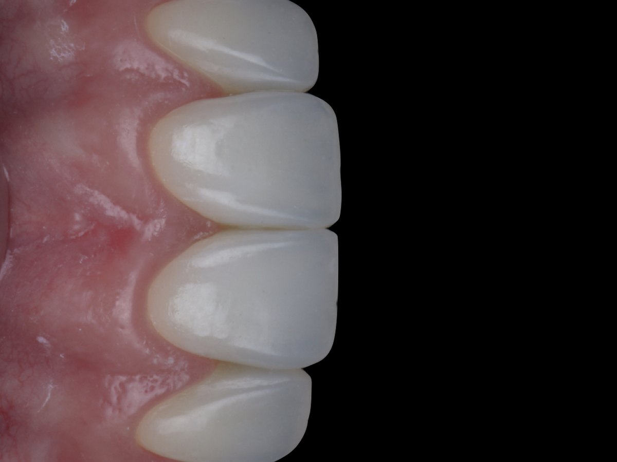 Polished anterior composite restorations seen from the side