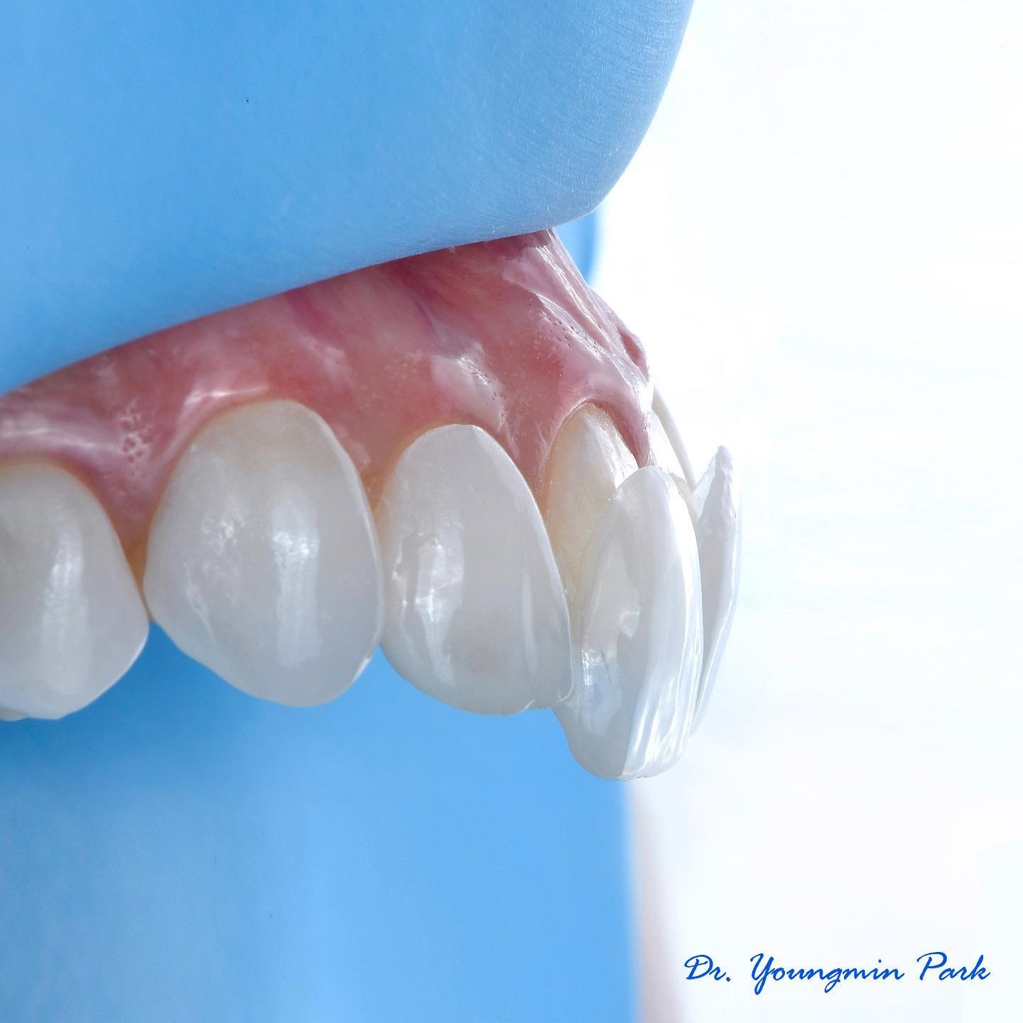 Ceramic veneers seated on the upper anterior teeth, with one veneer being placed at the lateral incisor